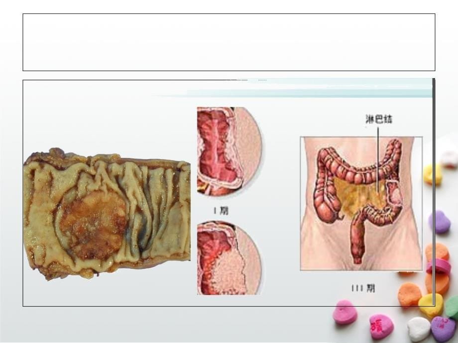 恶性肿瘤病人常见症状的护理.ppt_第5页