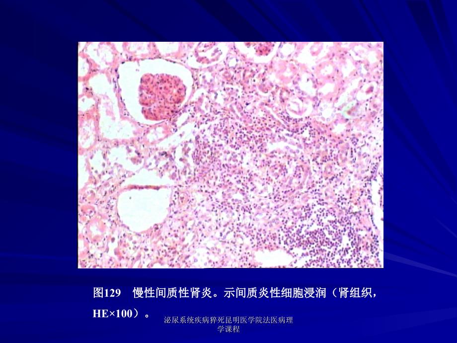 泌尿系统疾病猝死昆明医学院法医病理学课程课件_第4页