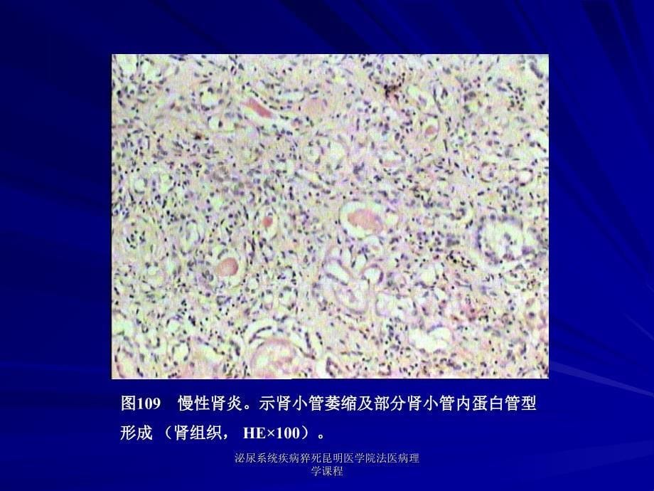 泌尿系统疾病猝死昆明医学院法医病理学课程课件_第5页