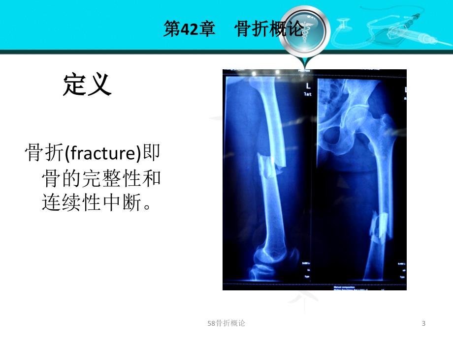 58骨折概论课件_第3页