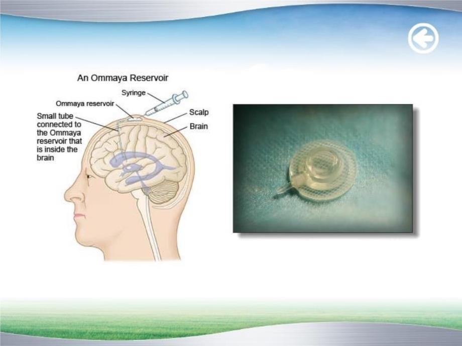 ommaya囊的护理教学提纲_第4页