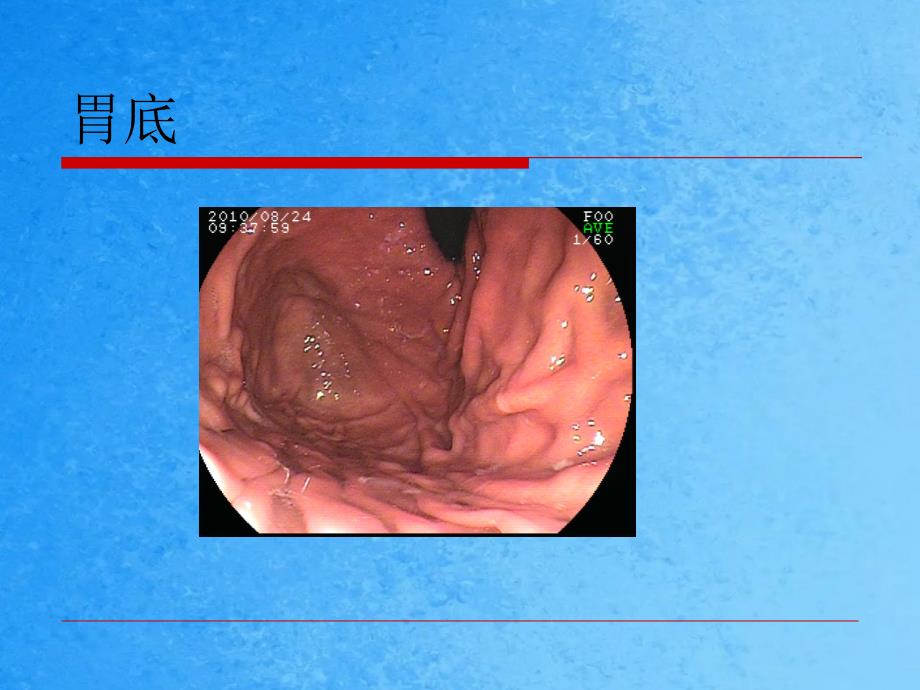 胃镜检查速读ppt课件_第3页