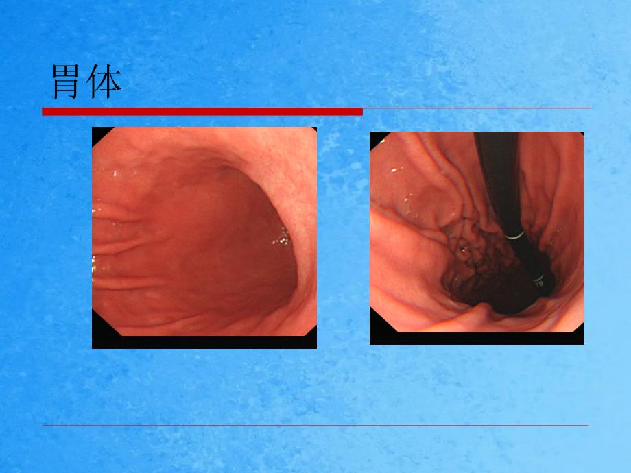 胃镜检查速读ppt课件_第4页