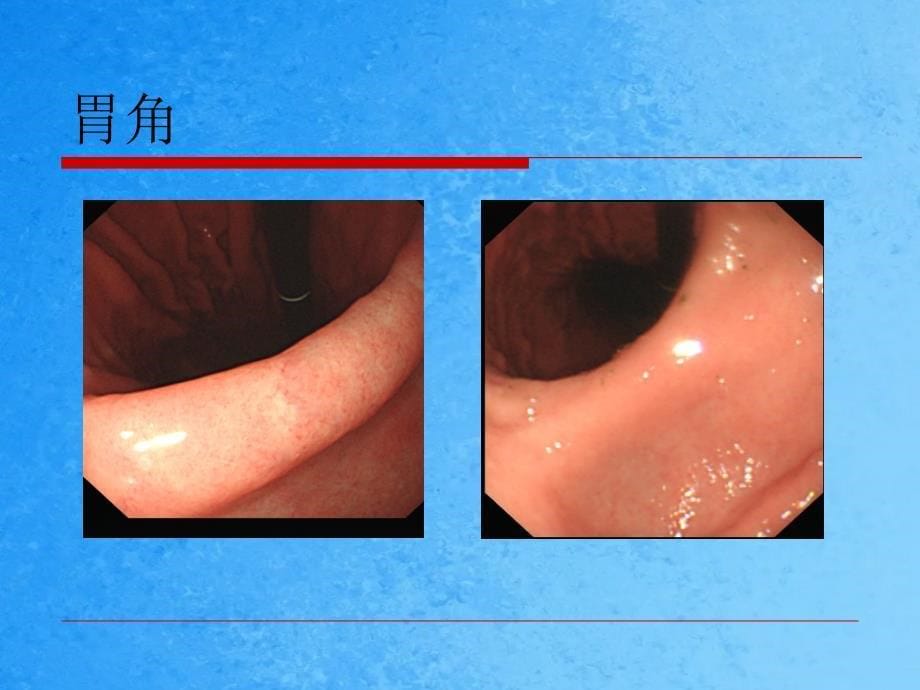 胃镜检查速读ppt课件_第5页