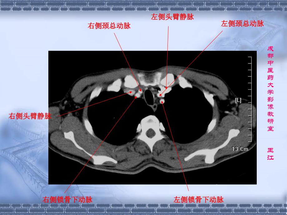 肺部CT肺部纵隔窗课件.ppt_第1页