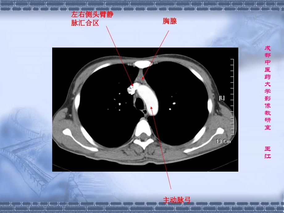 肺部CT肺部纵隔窗课件.ppt_第3页