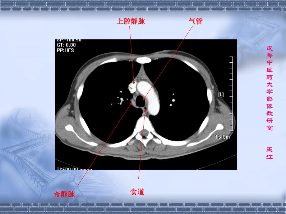 肺部CT肺部纵隔窗课件.ppt_第4页