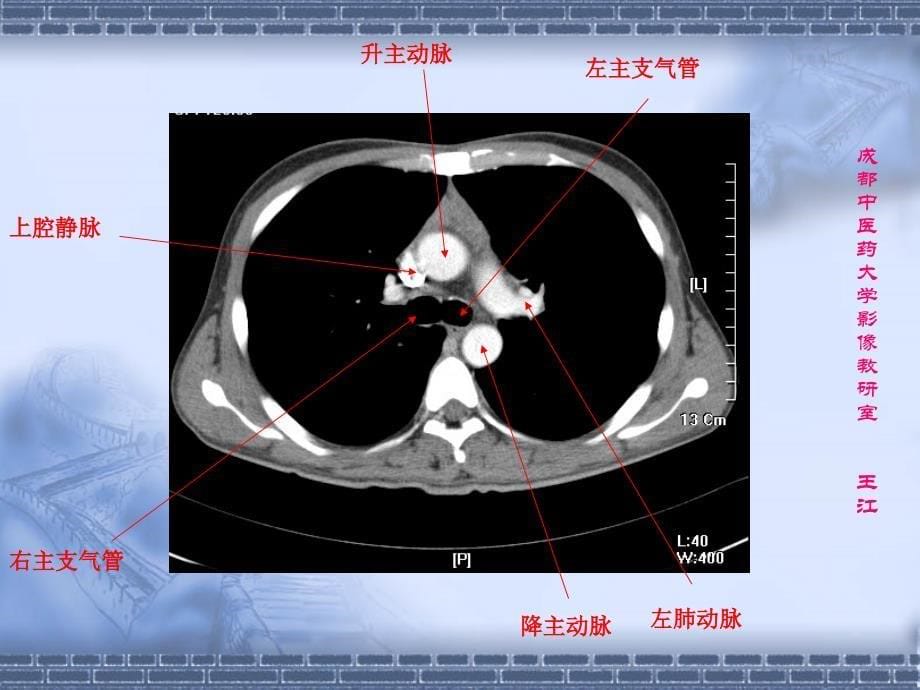 肺部CT肺部纵隔窗课件.ppt_第5页