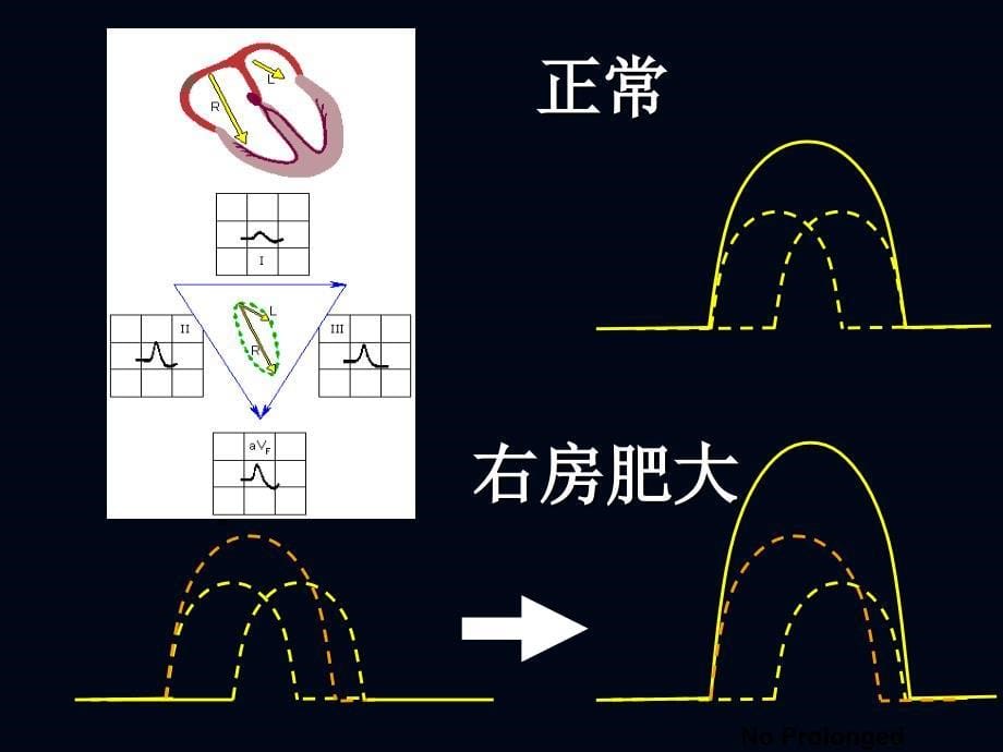 心电图2肥大缺血_第5页