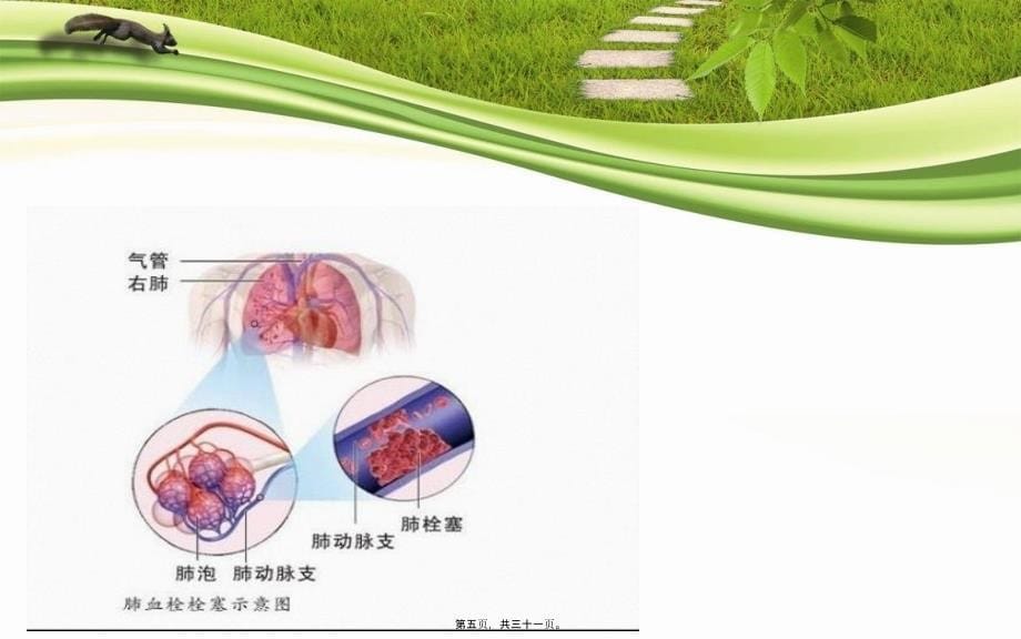 医学专题—围手术期肺栓塞(ZP)_第5页