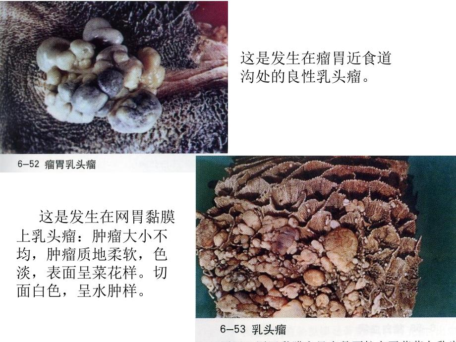 《肿瘤病理变化》PPT课件_第4页