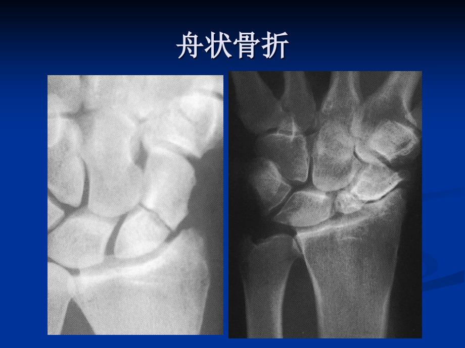 腕部舟状骨骨折_第2页