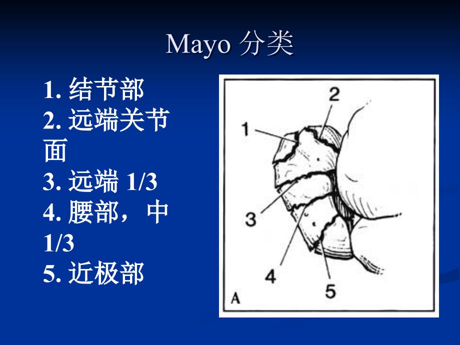 腕部舟状骨骨折_第3页