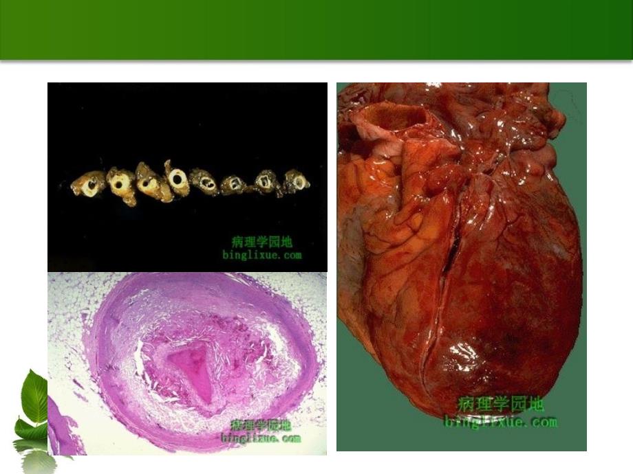 ACS急性冠脉综合征的诊断和治疗_第3页