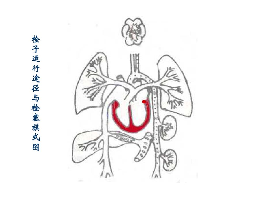 栓塞梗死课件_第3页