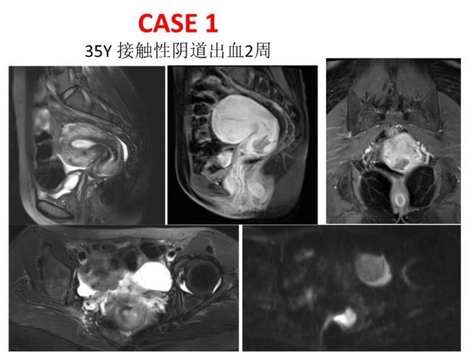 最新子宫内膜癌与宫颈癌相关解剖与影像表现二PPT课件_第3页