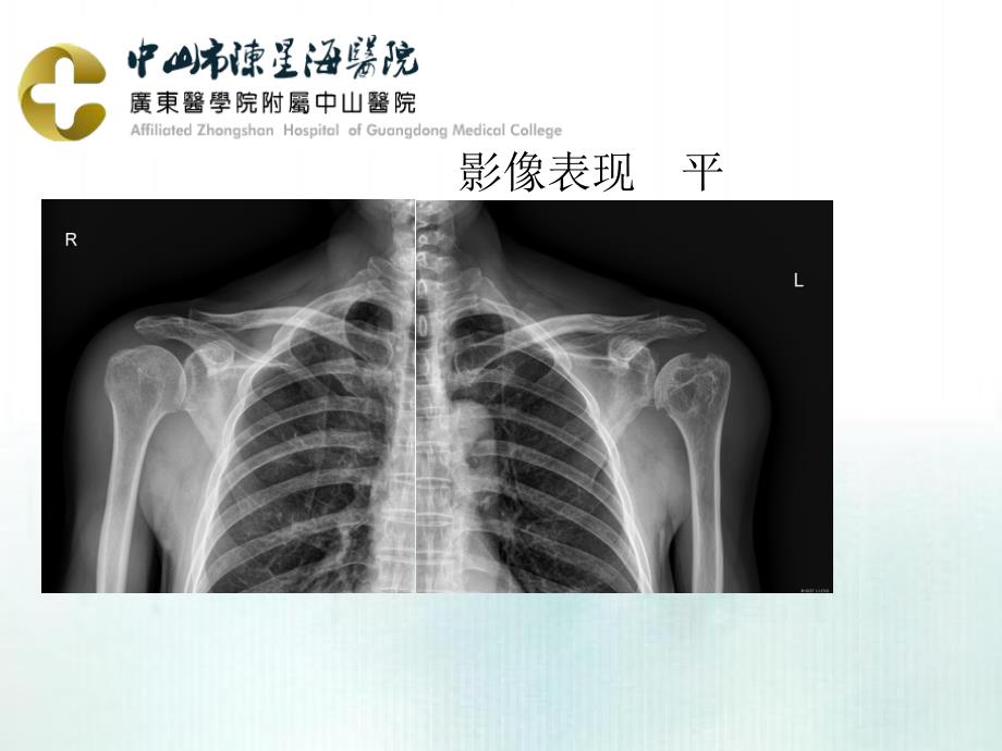 课件：米粒体滑膜炎影像表现.ppt_第3页