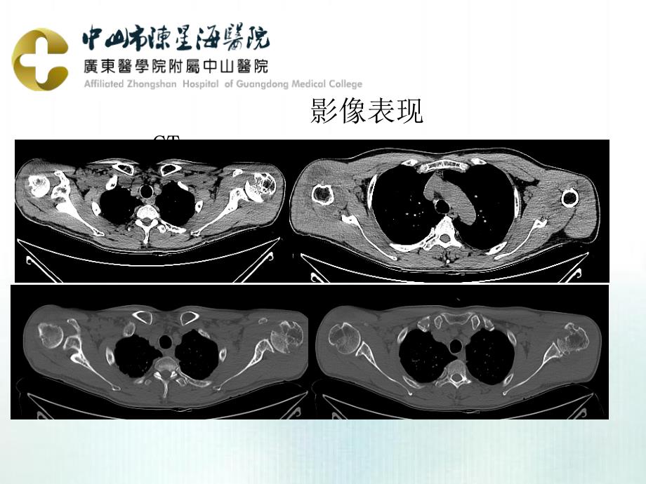 课件：米粒体滑膜炎影像表现.ppt_第4页