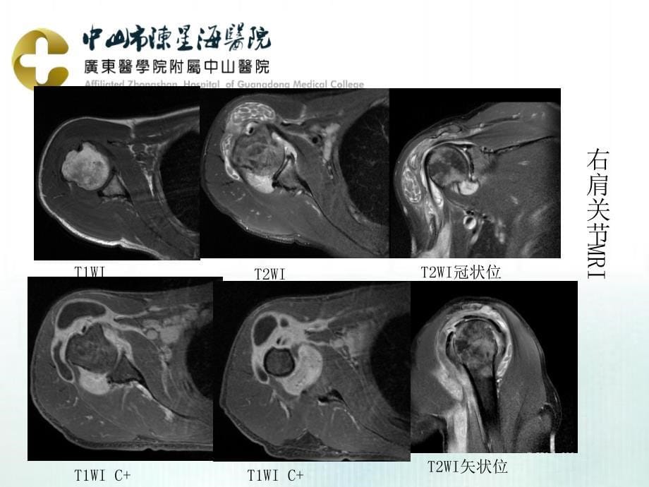 课件：米粒体滑膜炎影像表现.ppt_第5页