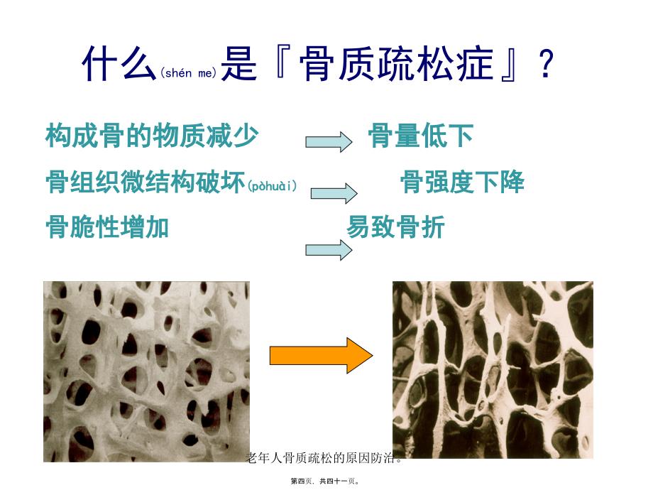 老年人骨质疏松的原因防治课件_第4页