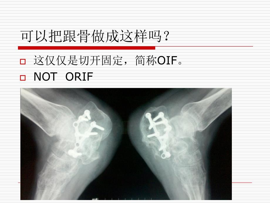 跟骨骨折ORIF的技巧_第4页