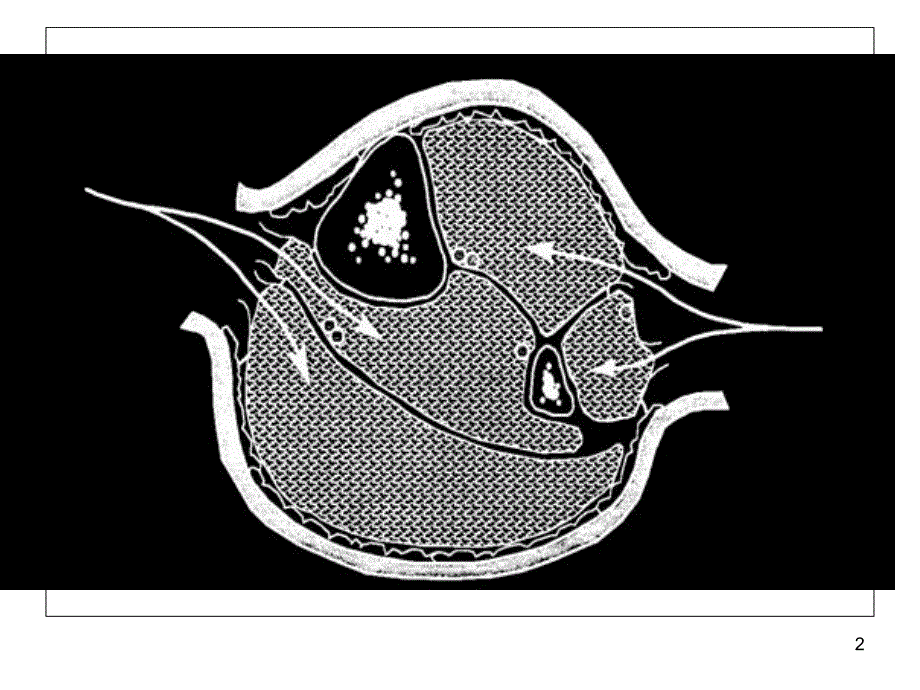 骨筋膜室综合征课件_第2页