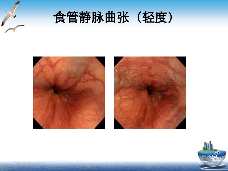 食管胃底静脉曲张治疗PPT幻灯片课件_第4页