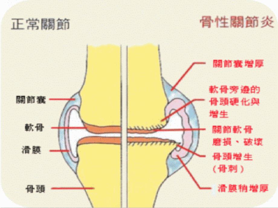 膝关节骨关节炎说的ppt课件_第3页