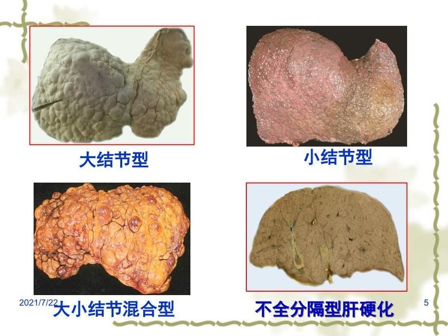 病理学肝硬化PPT课件_第5页