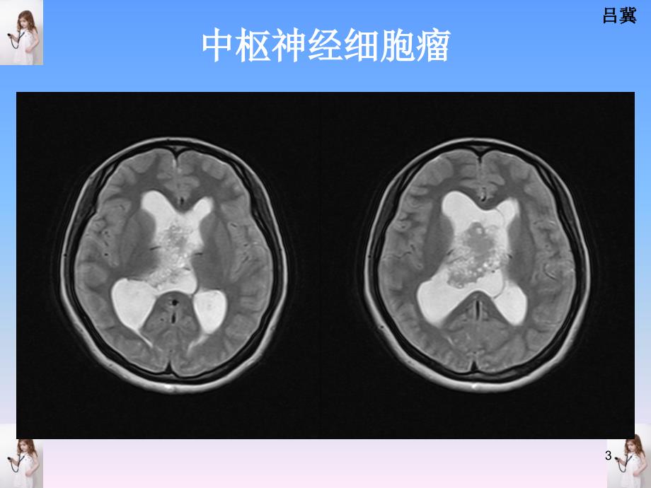 医影在线CNS疾病影像图库参考PPT_第3页