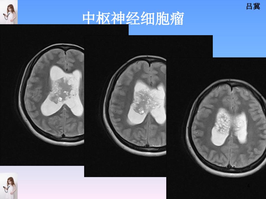 医影在线CNS疾病影像图库参考PPT_第4页