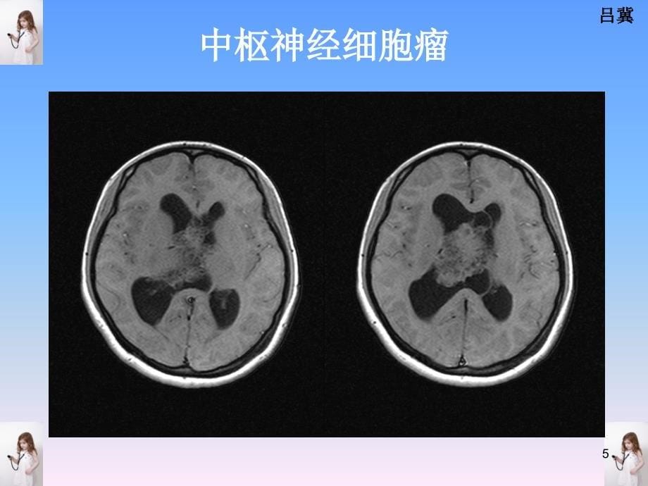 医影在线CNS疾病影像图库参考PPT_第5页