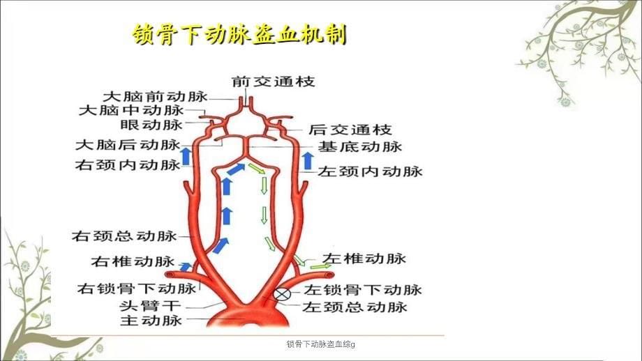 锁骨下动脉盗血综g_第5页