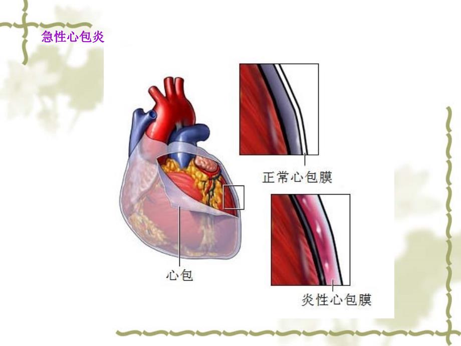 急性心包炎心电图表现_第3页