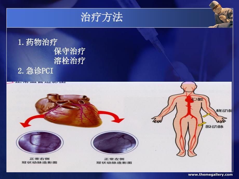 PCI术后护理 PPT课件.ppt_第3页