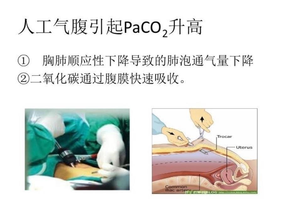 ETCO2监测在临床麻醉中的应用_第5页