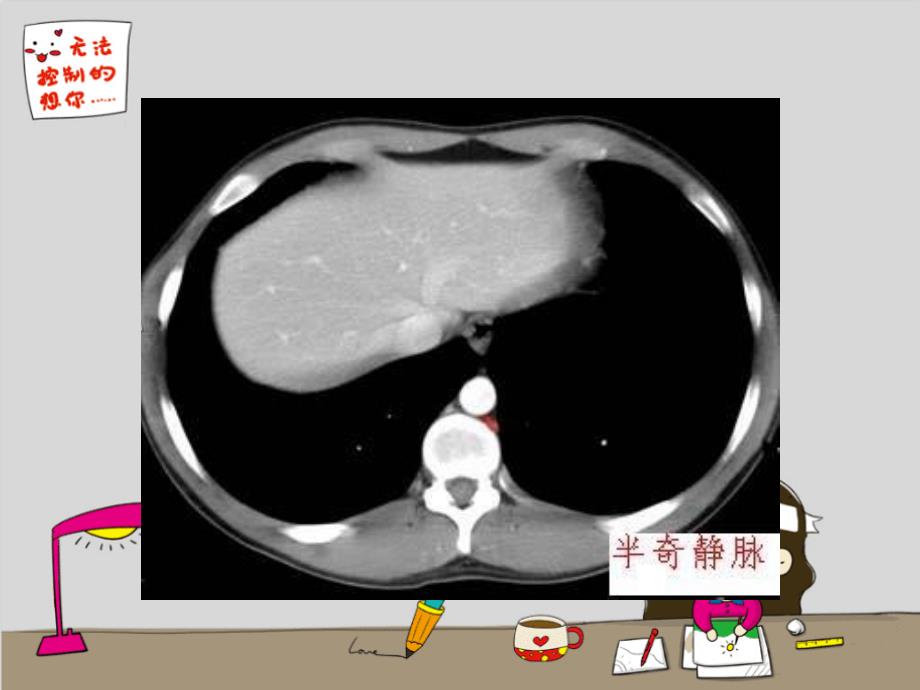 急诊急腹症影像_第4页