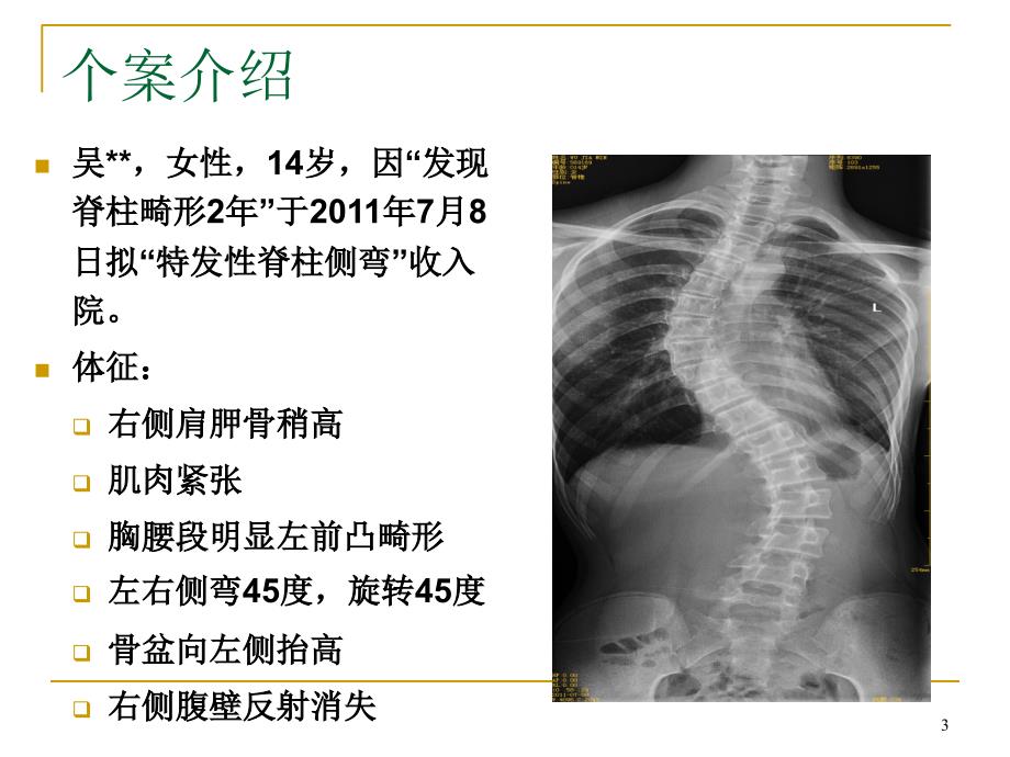 （优质课件）脊柱侧弯的个案护理_第3页