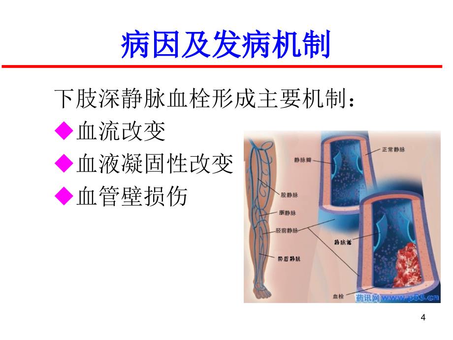 妇科手术后下肢静脉血栓PowerPoint 演示文稿_第4页