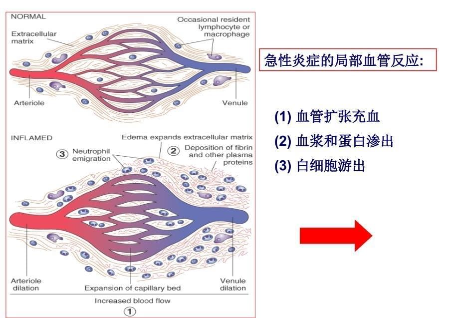 病理学课件：第4章-炎症2_第5页