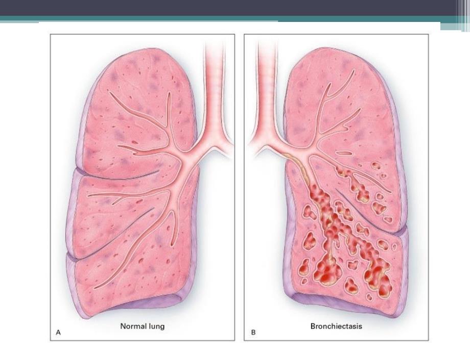 内科护理学支气管扩张_第4页