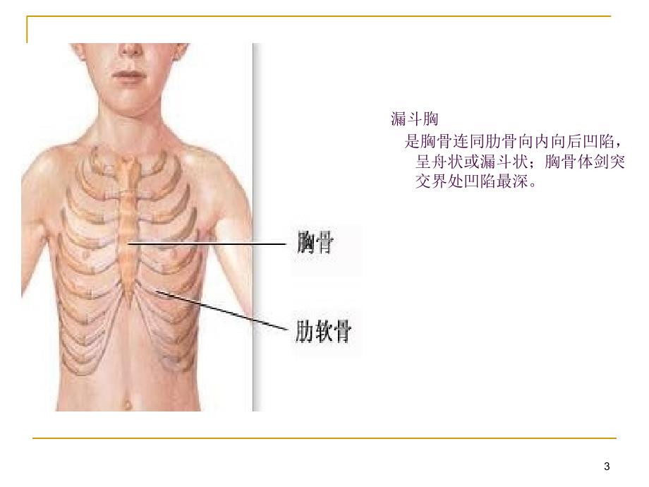 漏斗胸ppt课件_第3页