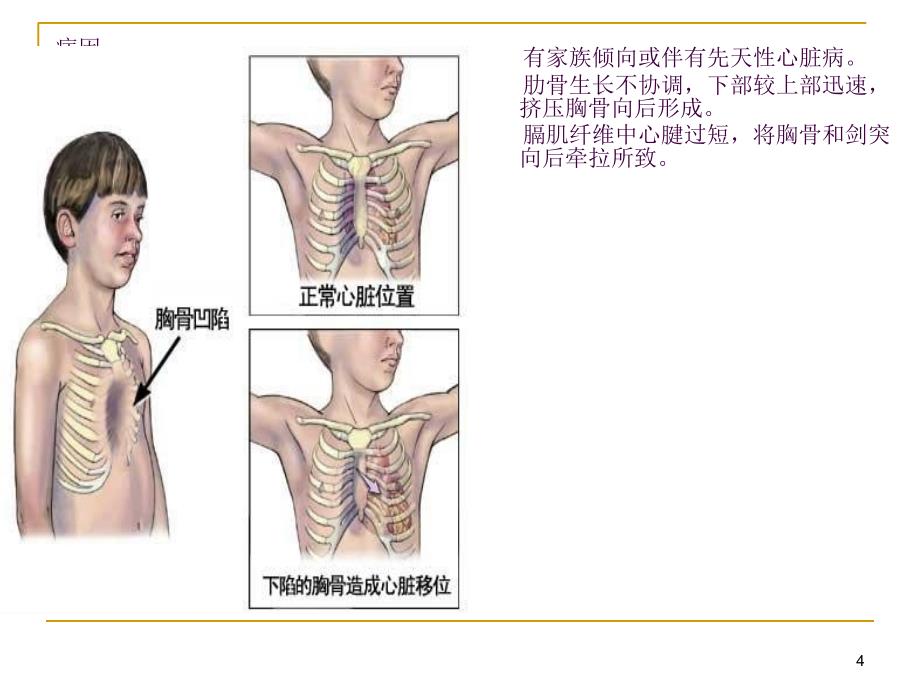 漏斗胸ppt课件_第4页