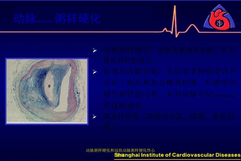 动脉粥样硬化和冠状动脉粥样硬化性心脏病课件_第4页