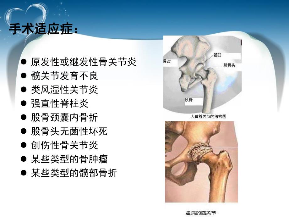 髋关节置换术后功能锻炼健康指导_第2页