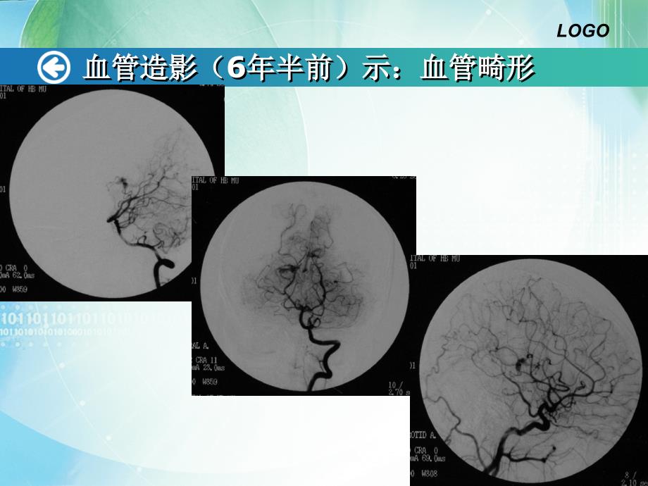 丘脑病变2例分析_第3页