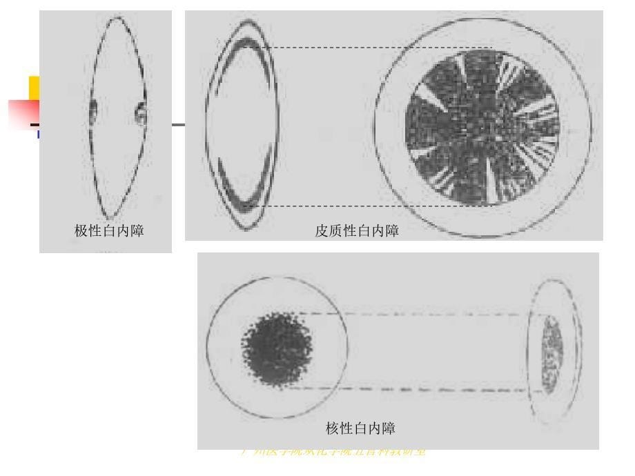 第十章 晶状体病_第5页