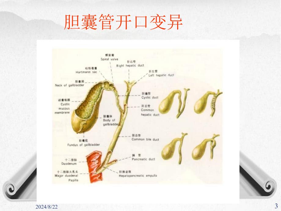 《胆囊结石伴胆囊炎》课件_第3页