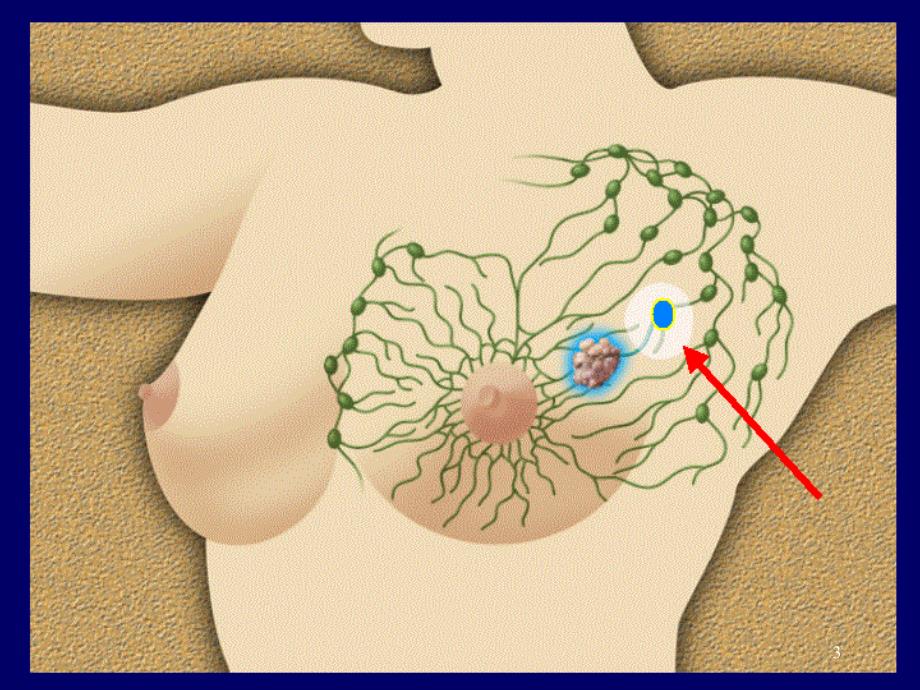 乳腺癌诊断及分期ppt课件_第3页