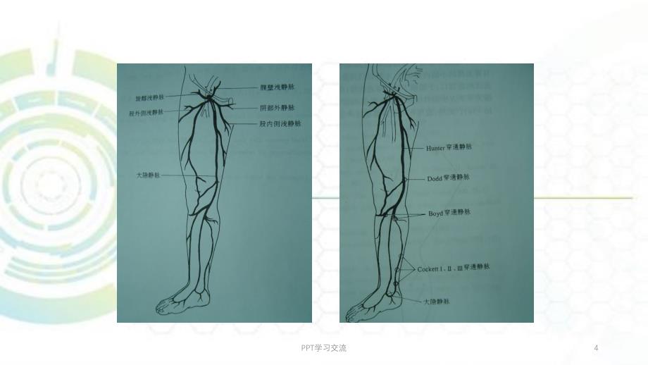 单纯性下肢静脉曲张课件_第4页